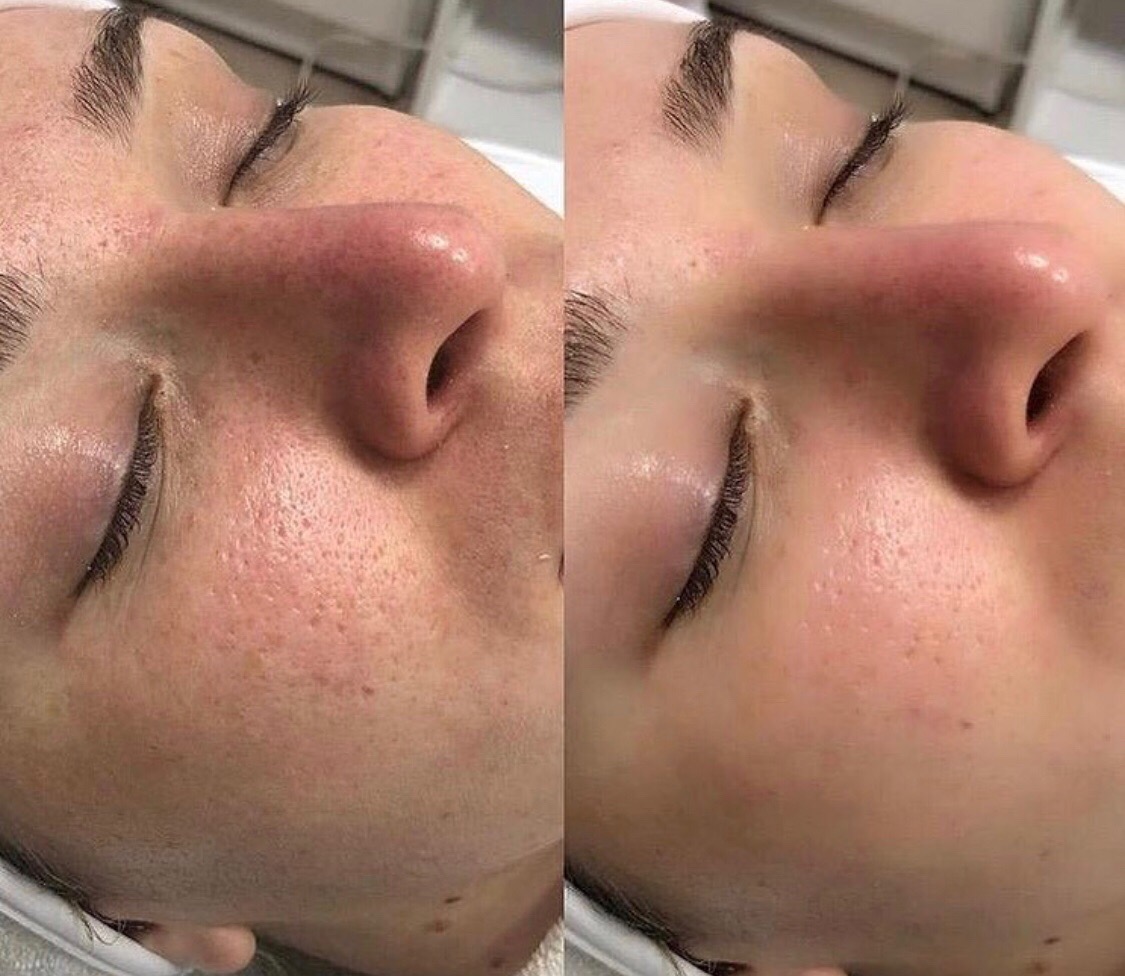 Голливудский гидропилинг HydraFacial ® в Москве - цены, запись на прием Клиника