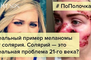 Меланома от солярия — реальный пример
